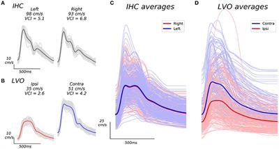 Decision Criteria for Large Vessel Occlusion Using Transcranial Doppler Waveform Morphology